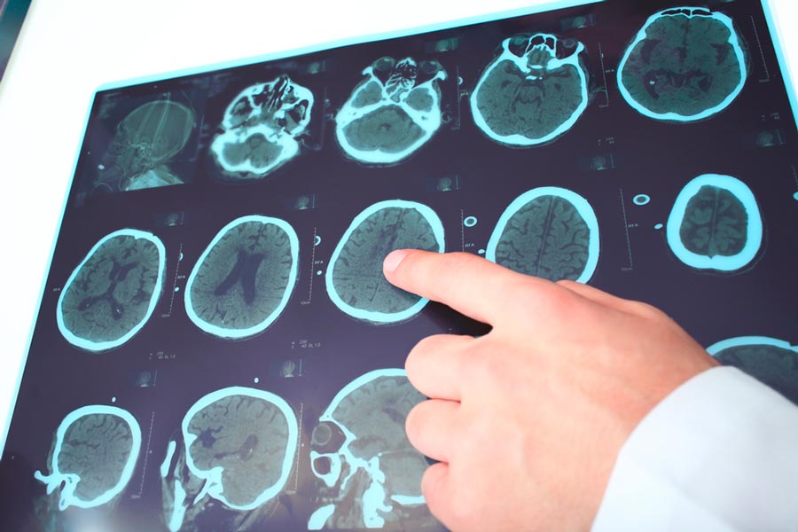 Multiple Sclerosis