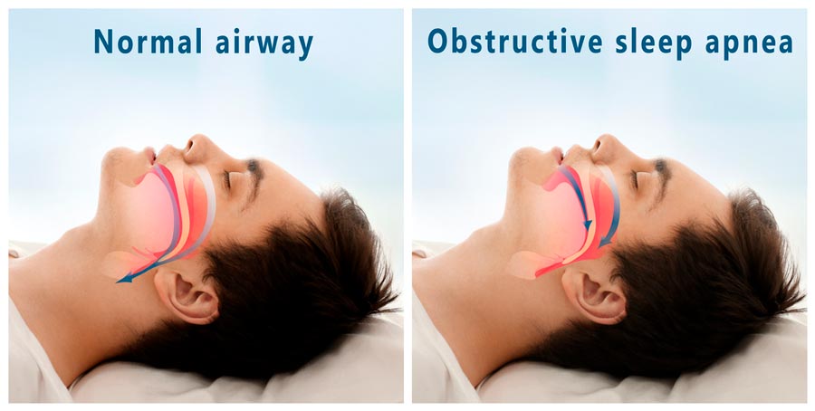 Obstructive sleep apnea